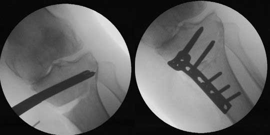 a wedge of bone graft is placed in the void and then the osteotomy site stabilized with a plate and screws